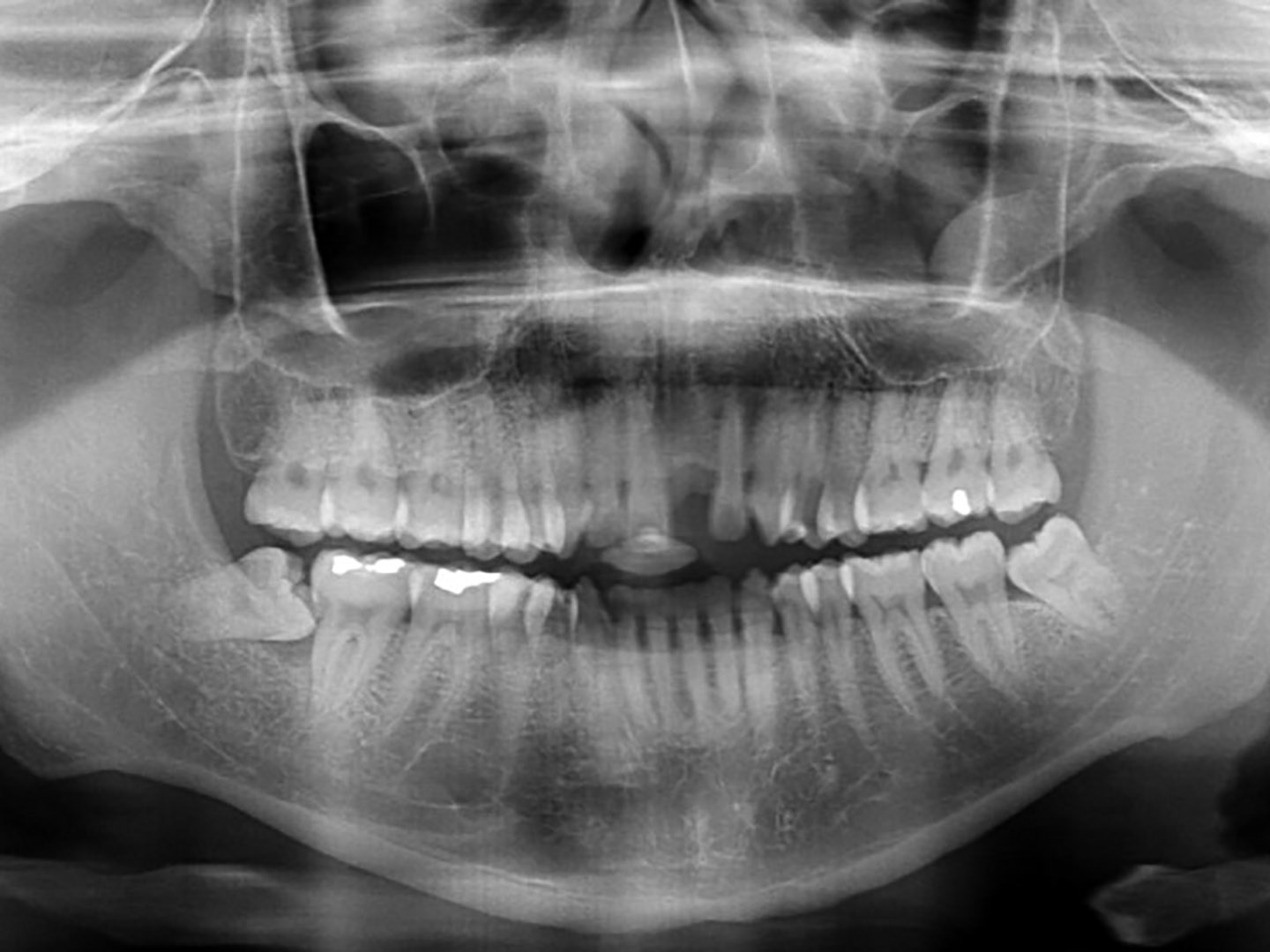 X-ray of teeth and jaw - Oral & Maxillofacial Surgery in Tucson
